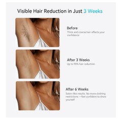 Laser Hair Removal Device Painless Long Lasting Results Men And Women
