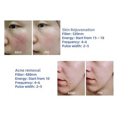 3In1 OPT IPL Laser Hair Removal Machine Pico Tattoo Removal RF Skin Rejuvenation