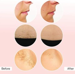 Sensilight Mini 100 RPL IPL Hair Removal Reduction Laser with Aftercare Product