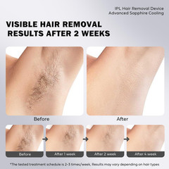 EUARNE Laser Hair Removal for Women and Man, IPL Middle, Ivory