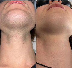4-in-1 Diode Laser Pico IPL RF Hair Removal Skin Rejuvenation Tattoo Removal