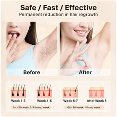 IPL Hair Removal Device 999999 Flashes – Permanent Hair Remover for Women & Men