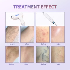 2IN1 1064/755/808nm Diode Laser Painless Tattoo Hair Removal Machine Pico Laser