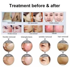 Handle Wand with Replacement 3 filters for OPT IPL Laser Hair Removal Machine