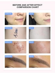 3-in-1 OPT beauty device, laser hair removal, tattoo removal, skin rejuvenation.