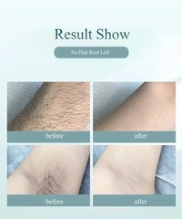 IPL Hair Removal Device for Women – Painless at Home Laser Epilator