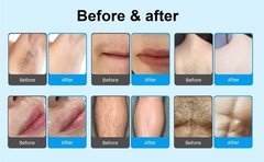 FreeShip Diode Laser Hair Removal Machine 755/808/1064 For HomeSalon
