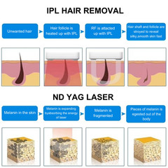 3 in 1 Laser E-Light IPL YAG Hair & Tattoo Removal Machine