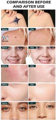 Upgraded FAC Diode Pico Laser Hair Reduction Tattoo Removal Salon Machine