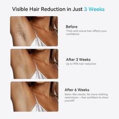 Painless Hair Removal Device – 8-Min Full Body, No Replacement Heads Required
