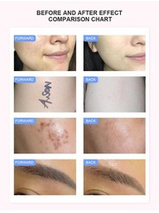 OPT 2-in-1 Hair Removal Machine Full Body Use Skin Smooth Reduce Unwanted Hair