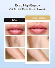 NEW – Innza Permanent Painless Facial & Body Laser Hair Removal Device JD-TM016