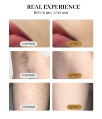 755nm 808nm 1064nm Diode Laser Hair Removal Machine Professional