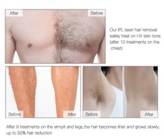 BARESKIN IPL hair removal device for body face bikini, gift for her