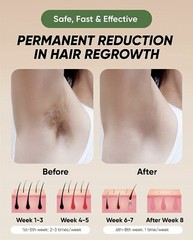 Xsoul At-home IPL Hair Removal 999,999 Flashes Painless Hair Remover