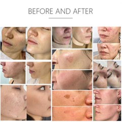 Permanent OPT IPL Laser Hair Removal Machine Whitening Skin Rejuvenation M22