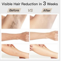 BoSidin Pioneer-Pro Permanent Hair Removal Device IPL Home Use (Pro) D-1103