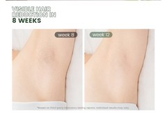 XSOUL At-Home IPL Permanent Hair Removal Tool for Women and Men