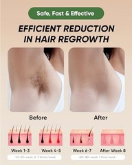 XSOUL At-Home IPL Hair Removal 999,999 Flashes Painless Hair Remover – White