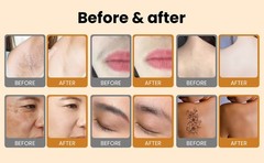 2 in 1 LCD Touch Handle Diode Laser Hair Removal & Pico Tattoo Removal Machine