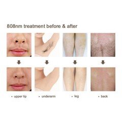 2026 Painless 755 808 1064 Laser Permanent Hair Removal Machine Skin Whitening