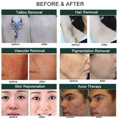 3 in1 OPT YAG Laser Tattoo Hair Removal Machine RF Skin Rejuvenation Lift Device