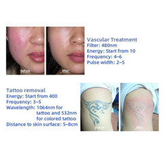IPL OPT RF Nd Yag Picosecond Laser Hair Removal Tattoo Pigment Removal Machine