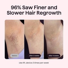Wavytalk IPL Hair Removal Device, Bare It for Face Body Bikini – Long-Lasting