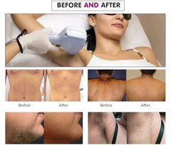 2026 Ice Titanium Soprano Permanent Painless Diode Laser Hair Removal Machine
