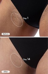 INIA FOND IPL Laser Hair Removal Device At-Home Permanent Hair Reduction NIB