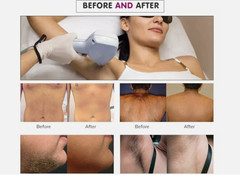 808 laser hair removal device, ice platinum hair removal head, fast hair removal