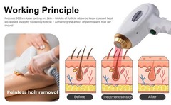 2026 Permanent Depilation Diode Laser Hair Removal Machine 755 808 1064nm