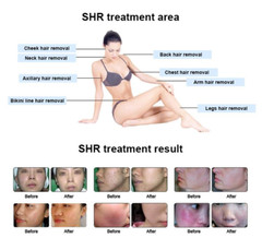 755 808 1064nm Diode Laser Hair Removal Picosecond Nd Yag Laser Tattoo Removal