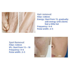 IPL OPT RF Nd Yag Picosecond Laser Hair Removal Tattoo Pigment Removal Machine