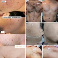 Ice Titanium 755 808 1064nm 1200W 1800W Nonpain Diode Laser Hair Removal Machine