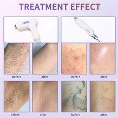110V Diode Laser Hair Removal Machine Picosecond Laser Tattoo Removal Machine