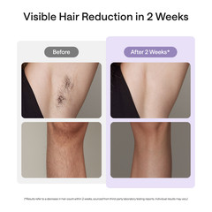 ULIKE Air 10 IPL Laser Hair Removal Device with Skin Sensor &Ice Cooling