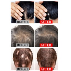 USB 5 Models Infrared Red Light Therapy Pad Hair Regrowth hair Loss Treatment