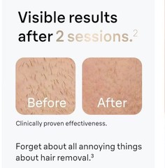 Professional Laser Hair Remover Body Hair Removal | Skin Leg Bikini Arm Hair