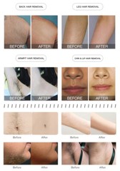 2In1 Diode Laser Hair Removal ND YAG Picosecond Tattoo Removal Skin Care Machine