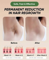 XSOUL At-Home IPL Hair Removal for Women and Men Permanent 999,999 Flashes.