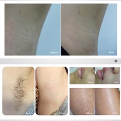 Painless IPL/OPT Hair Removal Laser Skin Rejuvenation Pigment Removal Machine