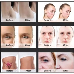755 808 1064nm 2In1 Diode Laser Hair Removal Pico Laser Tattoo Removal Machine