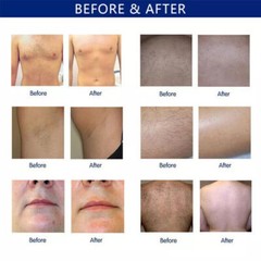 755nm 810nm 1064nm Diode Laser Permanent Hair Removal Machine For All Skin Hair