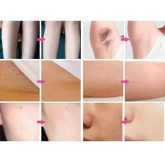 Painless 755nm 808nm1064nm Diode Laser Hair Removal Skin Rejuvenation Machine