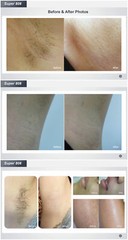 1200W Handle Super 808nm Diode Laser Machine Hair Removal Skin Rejuvenation