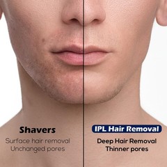 Luxduo Ipl Hair Removal Whole Body Hair Removal For Men And Women At Home