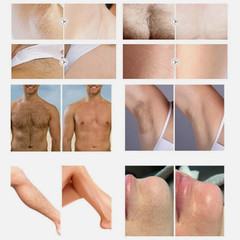 High-quality 755/808/1064nm laser hair removal device, painless hair removal.