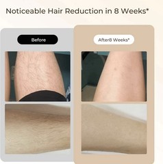 IPL Laser Hair Removal Device for Women & Men – 900K Flashes, 9 Levels