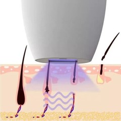 IPL Pro Cordless Laser Hair Removal, SmartSkin Sensor, SafeGuard Technology